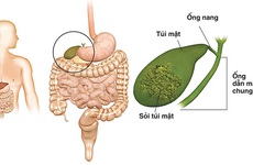 Bệnh ung thư túi mật: Nguy hiểm cần được phát hiện và điều trị kịp thời