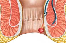 Polyp hậu môn là gì? Những điều cần biết về polyp hậu môn