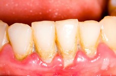 Vôi răng - tác hại và cách phòng ngừa