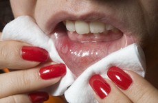 Loét áp-tơ bệnh viêm loét miệng có tác hại nghiêm trọng