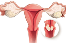 Cảnh báo: Những dấu hiệu ung thư buồng trứng không thể bỏ qua