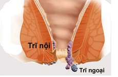 Thay đổi thói quen đại tiện cũng là cách phòng tránh bệnh trĩ hiệu quả