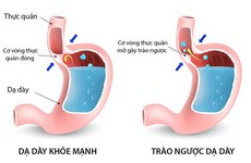 Bệnh trào ngược dạ dày thực quản có nguy hiểm không?