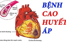 Bệnh tăng huyết áp: Kẻ giết người thầm lặng