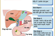 Nhận biết dấu hiệu ung thư gan qua từng giai đoạn