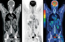 Chụp PET/CT phát hiện sớm ung thư - có cần thiết như mọi người vẫn nghĩ?