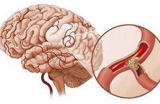 Có bao nhiêu dạng đột quỵ, dạng nào có nguy cơ tử vong cao nhất?