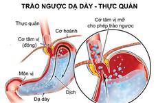 Giái pháp để bệnh trào ngược dạ dày không còn tái phát