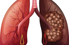 Các giai đoạn phát triển của ung thư phổi tế bào nhỏ và ung thư phổi không tế bào nhỏ