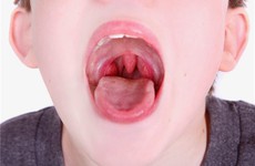 Trẻ 16 tuổi đã mắc ung thư vòm họng do bị hút thuốc lá thụ động
