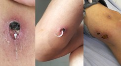 Giun rồng là giun gì? Bệnh giun rồng có chữa khỏi được không?
