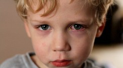 Liệu mắt đỏ là dấu hiệu của bệnh gì ngoài viêm giác mạc?