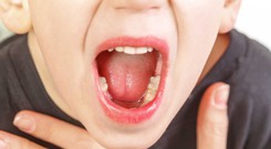 Viêm họng liên cầu khuẩn: Đừng chủ quan khi thấy những triệu chứng này
