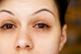 Các vấn đề nhiễm trùng mắt thường gặp trong mùa mưa cần biết