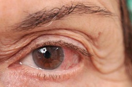 Các hướng dẫn chăm sóc giảm nhẹ triệu chứng đau mắt đỏ mà người bệnh nhất định phải biết