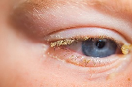 Cần làm gì khi đau mắt đỏ ngủ dậy 2 mí mắt bị dính vào nhau?
