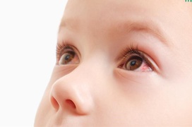Điều trị đau mắt đỏ ở trẻ em bằng những loại thuốc nào?