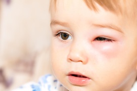 Những nguyên nhân gây bệnh đau mắt đỏ theo phân loại bệnh để phòng tránh đúng cách