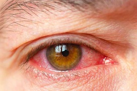 So sánh điểm giống và khác nhau giữa đau mắt đỏ và viêm màng bồ đào để không nhầm lẫn trong điều trị