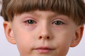 Đau mắt đỏ và tăng nhãn áp: Phân biệt bệnh để điều trị đúng cách