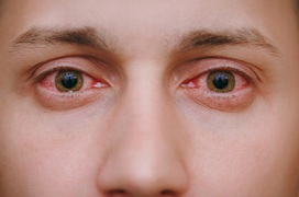 Sự khác biệt giữa đau mắt đỏ và viêm loét giác mạc không phải ai cũng biết