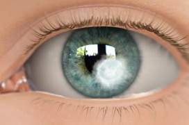 Đau mắt đỏ do kính áp tròng là gì? Bị đau mắt đỏ có được đeo kính áp tròng không?