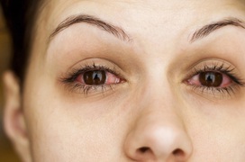 Đau mắt đỏ và viêm củng mạc: Những điều cần biết để tránh nhầm lẫn