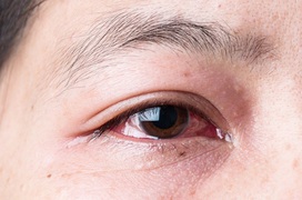 Những hình ảnh chi tiết nhất về triệu chứng của bệnh đau mắt đỏ