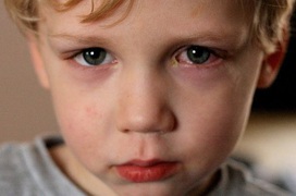 Đau mắt đỏ: Những biện pháp phòng tránh lây nhiễm từ người bệnh 