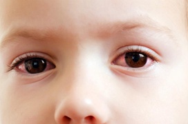 Nguyên nhân gây đau mắt đỏ và nguy cơ làm giảm thị lực nguy hiểm