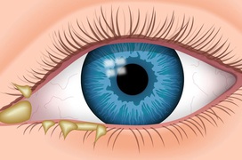 Mắt đổ ghèn là gì? Nguyên nhân và cách chữa mắt bé bị đổ ghèn