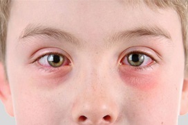 Mắt bị ngứa: Nguyên nhân và cách điều trị