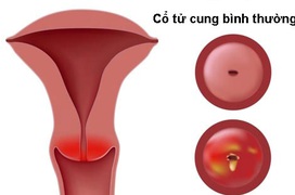 Thông tin từ A đến Z về bệnh viêm cổ tử cung