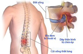 Thoát vị đĩa đệm cột sống thắt lưng: Nguyên nhân, dấu hiệu, các cấp độ và cách điều trị