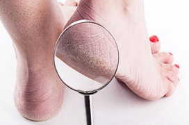 Gót chân bị tróc da là bệnh gì? Làm thế nào để cải thiện?