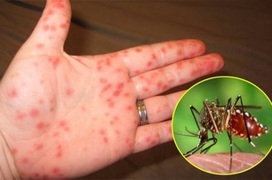 Tái nhiễm virus dengue có thể làm bệnh sốt xuất huyết nghiêm trọng hơn