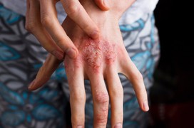Làm thế nào để đối phó với các bệnh về da vào mùa mưa?