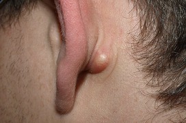 Nguyên nhân gây u cục sau tai là gì? Khi nào cần thăm khám bác sĩ?