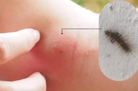 Phát ban do sâu bướm: Cách phát hiện và điều trị