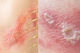 Các bệnh da do virus hay gặp vào mùa nắng nóng