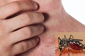 4 vấn đề sức khoẻ bạn có thể gặp sau khi khỏi sốt xuất huyết
