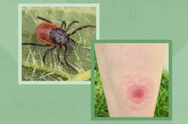10 bệnh lý lây truyền từ bọ ve mà mọi người cần cẩn trọng
