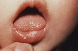 Cách phân biệt nấm miệng và nhiệt miệng ở trẻ