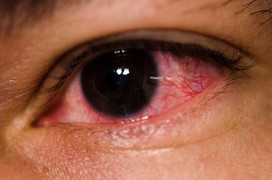 Làm gì để phòng trách dịch bệnh đau mắt đỏ?