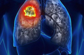 Biểu hiện bệnh ung thư phổi ở từng giai đoạn