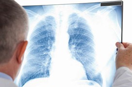 Viêm nấm phổi: Nguyên nhân và cách điều trị