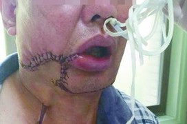 Các phương pháp điều trị ung thư biểu mô khoang miệng