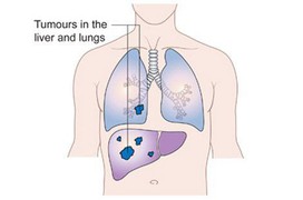 Ung thư gan di căn phổi: Dấu hiệu, điều trị và cách chăm sóc