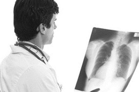 Các phương pháp điều trị ung thư phổi di căn xương và tiên lượng sống cho bệnh nhân