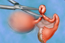 Tìm hiểu về phương pháp phẫu thuật ung thư buồng trứng 